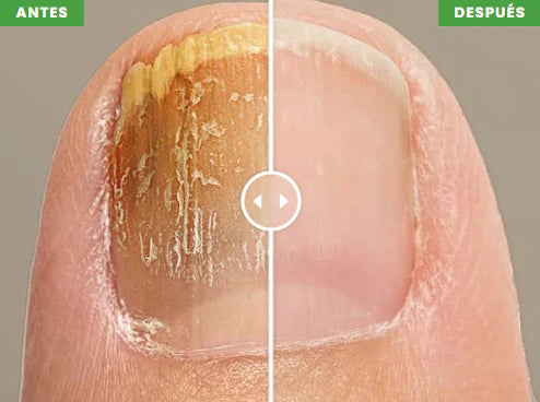 Eliminador de Hongos de Uñas